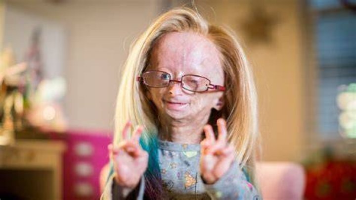 Adalia Rose died at the age of 15