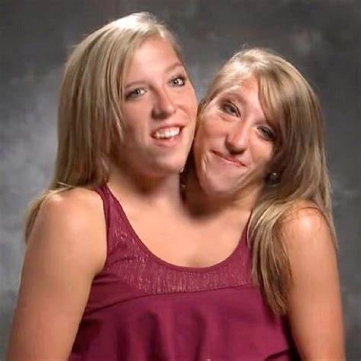 Conjoined Twins Abby and Brittany Hensel Family