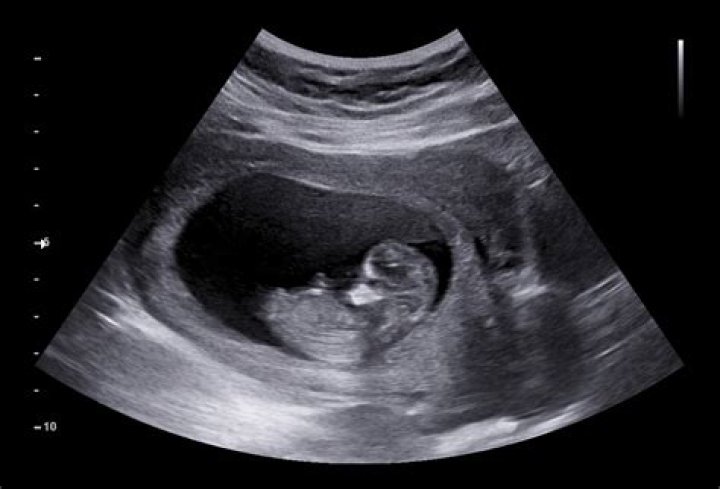 Fetus Ultrasound