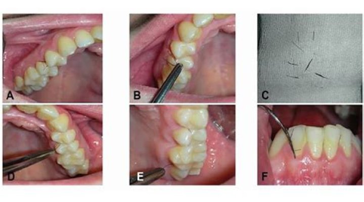 Hair Growing From Gums