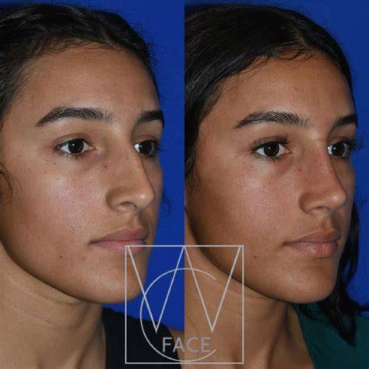 Hayley Vernon rhinoplasty surgery