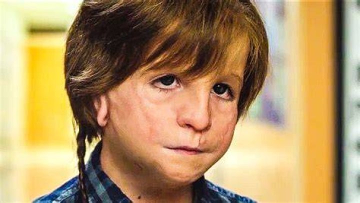Is the kid in the movie Wonder really deformed?