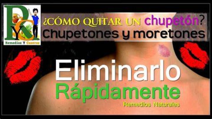 ¿Los chupetones duelen?