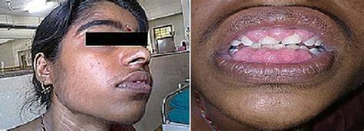 Patient With Gingival Hirsutism