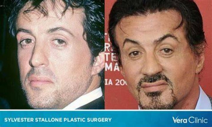 Sylvester Stallone Heart Surgery: Did He Get A Stroke? Health Update