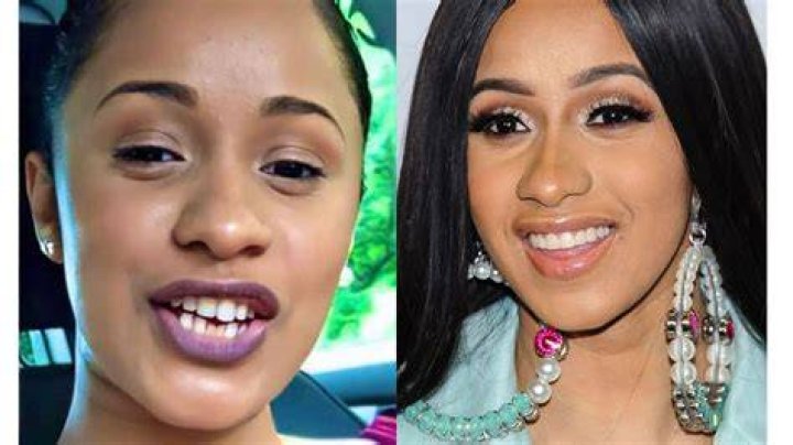 What did Cardi B have done to her teeth?