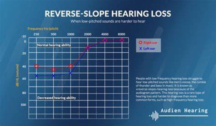 Woman With Reverse-Slope Hearing Loss Unable To Hear Men